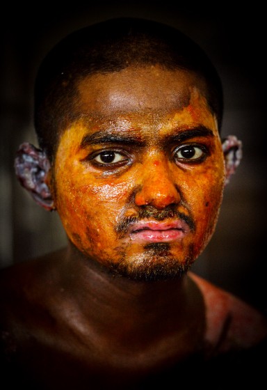 Victims of Petrol Bomb