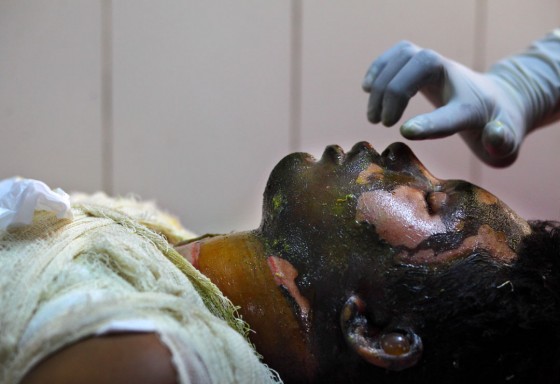 Victims of Petrol Bomb