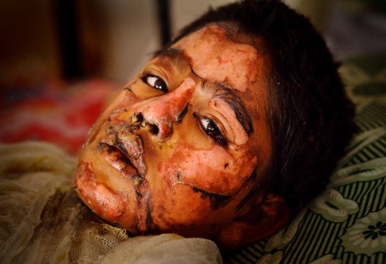 Victims of Petrol Bomb
