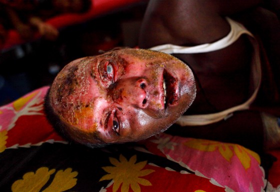 Victims of Petrol Bomb