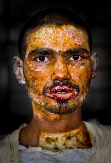 Victims of Petrol Bomb
