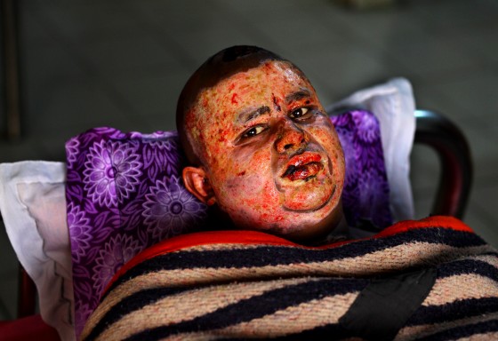 Victims of Petrol Bomb