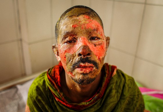 Victims of Petrol Bomb