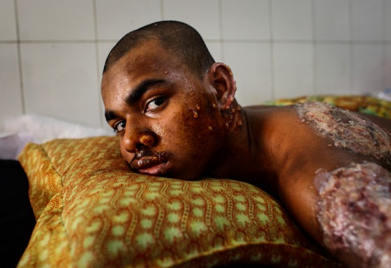 Victims of Petrol Bomb
