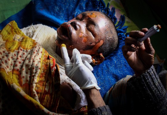 Victims of Petrol Bomb